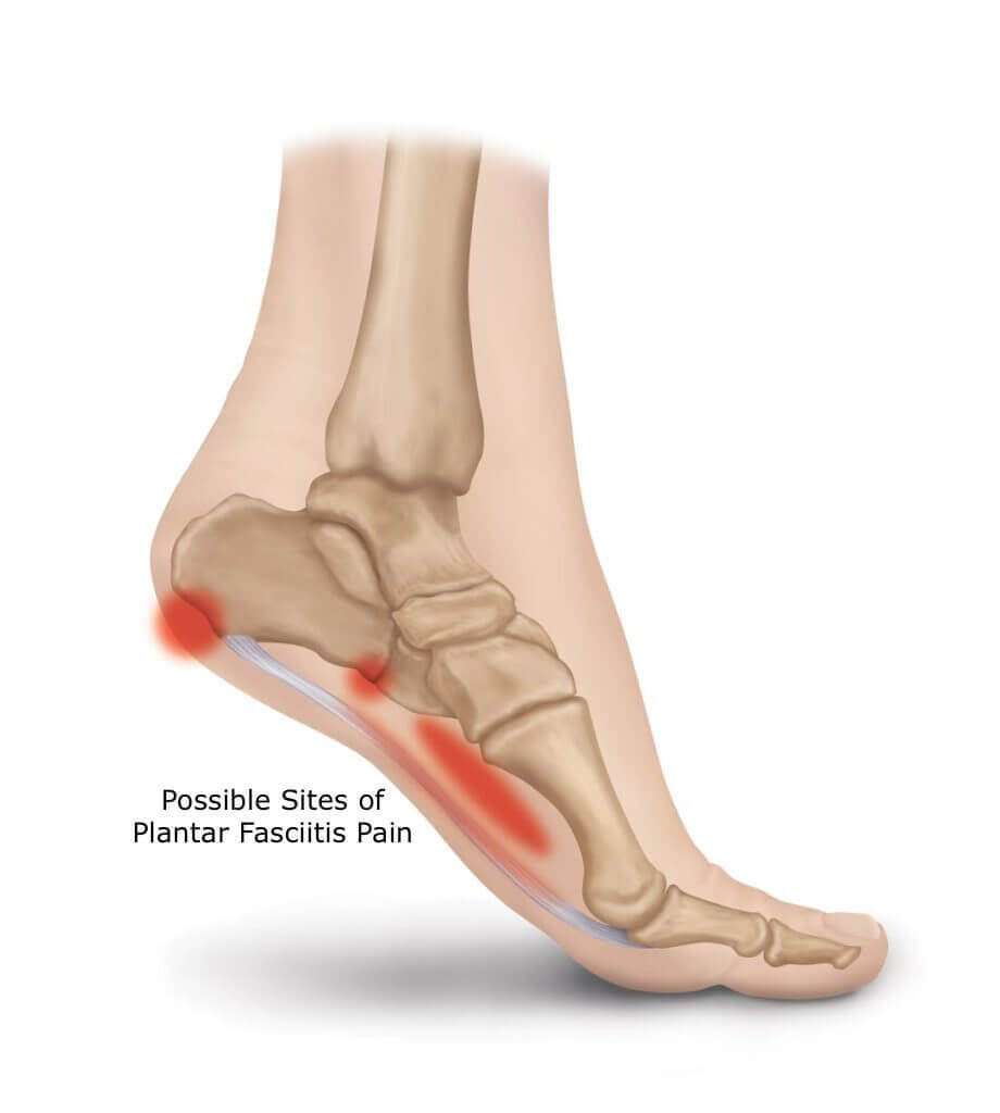 Heel pain Information | Mount Sinai - New York