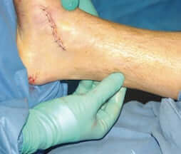 Plantar Fasciitis Surgery Types of Surgical